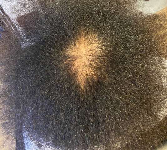The Most Common Causes of Alopecia